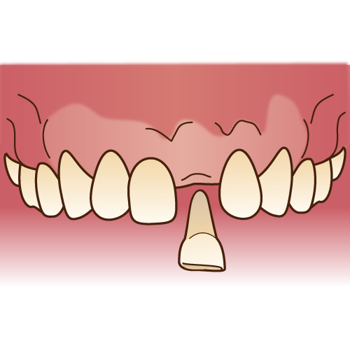歯を失うと脳が痩せる？厚生労働省のデータが示す「抜歯と認知症」の意外な関係