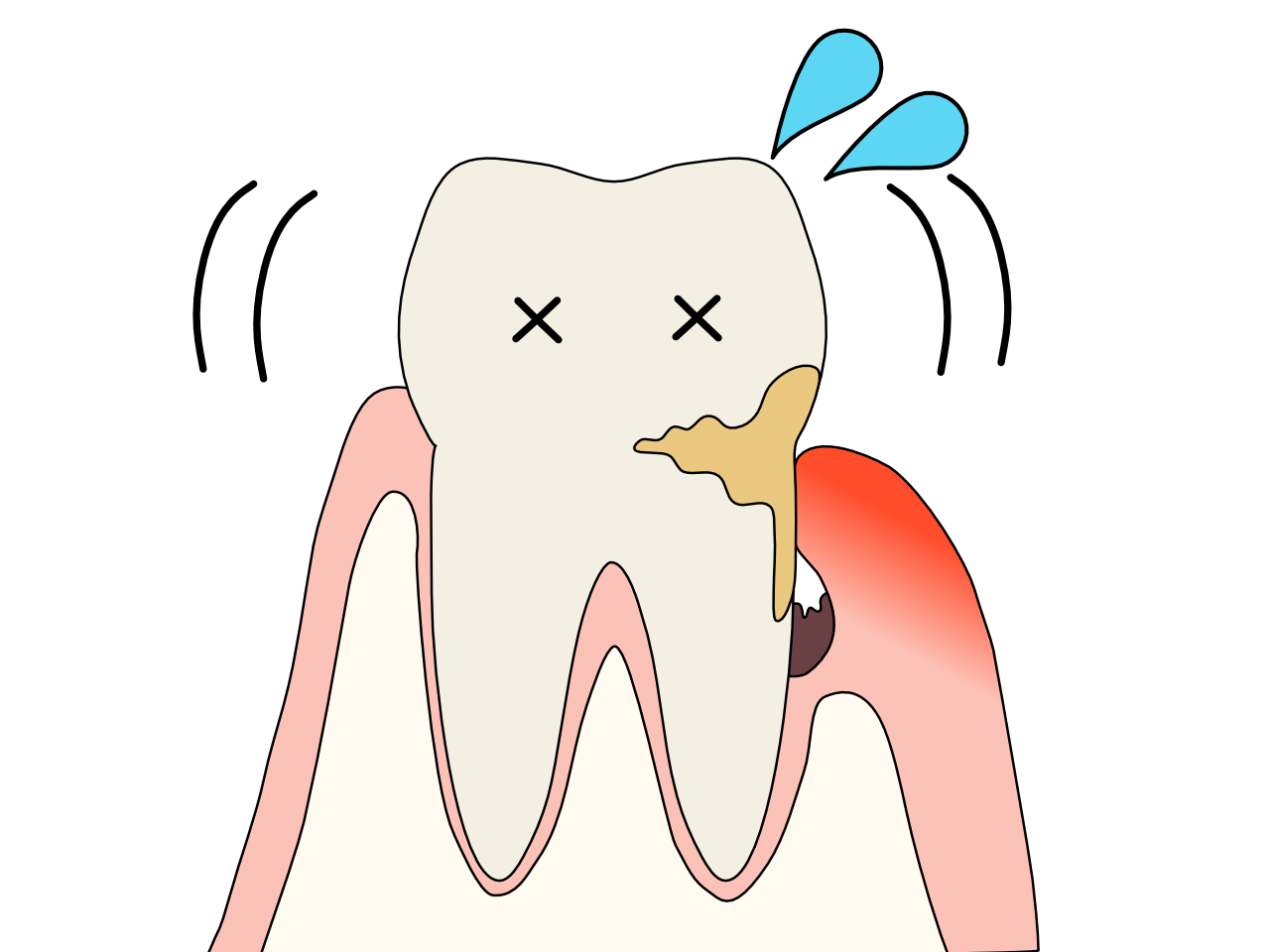 歯周病の歯2.png__PID:1d61a166-3bb4-475d-adb0-4457d2a0540f